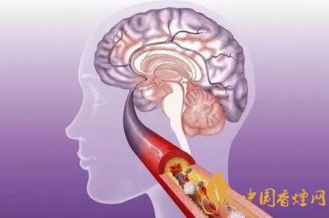 吸煙埋禍根中年中風找上門